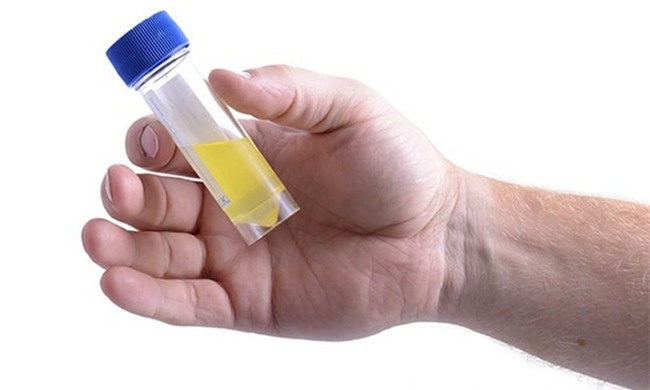 Nước tiểu có bọt: Dấu hiệu báo động không thể bỏ qua - Ảnh 4.