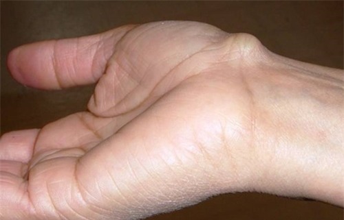 Bỗng xuất hiện cục nổi trên cổ tay, đừng vội vàng bỏ qua vì đó là dấu hiệu cảnh báo bệnh vô cùng hãi hùng - Ảnh 3.