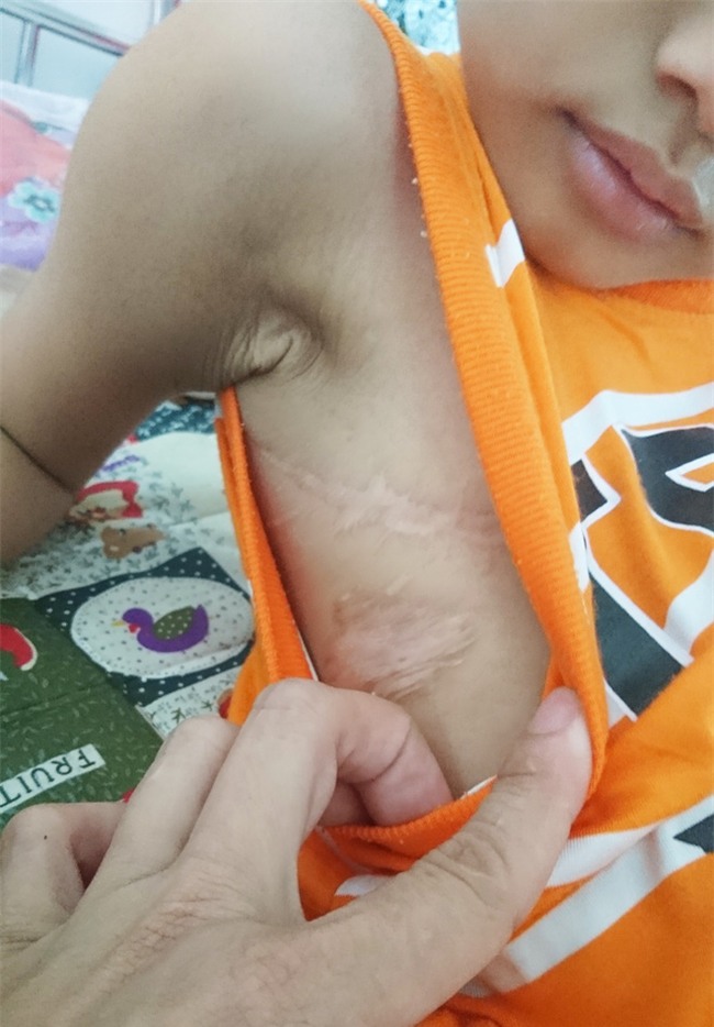 Người mẹ bất lực nhìn con trai 5 tuổi phải cắt thực quản, nửa người bị liệt hoàn toàn - Ảnh 2.