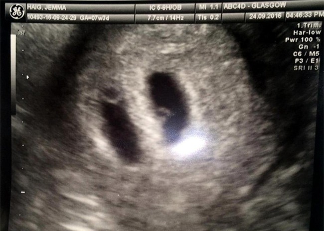 Để cậu bé này được ra đời, bố mẹ em đã phải đau lòng đánh đổi 2 mạng sống khác - Ảnh 2.