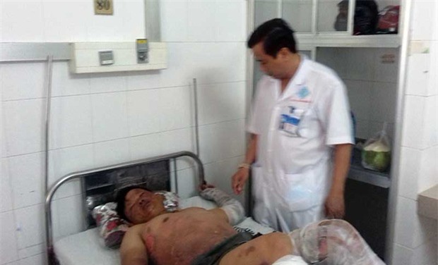 Bếp cồn cháy dữ dội, 11 người đang ăn tiệc cưới bị bỏng - Ảnh 1.