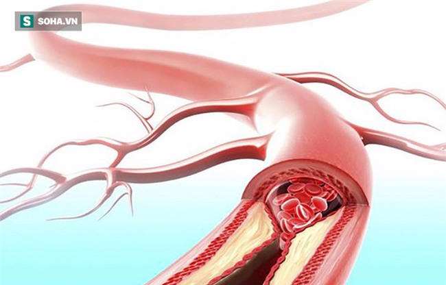 Bệnh tắc mạch máu dễ gây tử vong bất ngờ: 5 giải pháp này sẽ giúp bạn tự cứu mình - Ảnh 1.