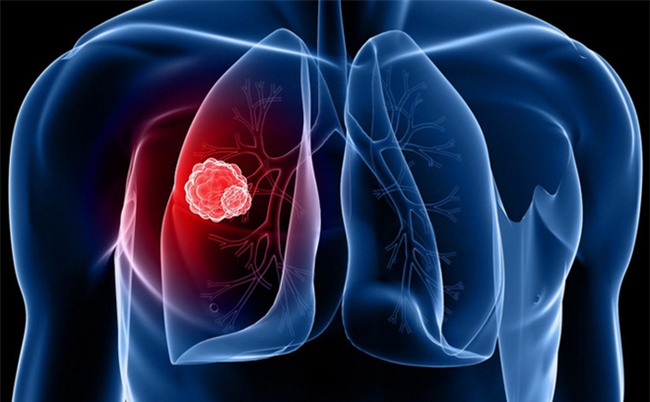 Xét nghiệm chỉ 70.000 đồng giúp chẩn đoán nhanh ung thư phổi: Hy vọng cho hàng triệu người