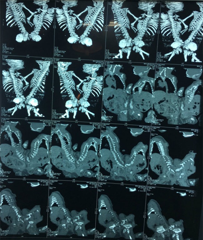 nam tren ban mo, me dau don thay 2 con gai song sinh chao doi chi co 1 cai mong - 2