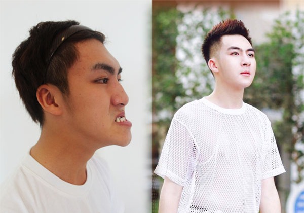 Sốc: Chàng trai Quảng Ninh mặt lưỡi liềm giờ đây đẹp như hotboy xứ Hàn-1
