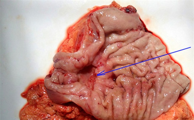 Chuyên gia chỉ rõ 4 nguyên nhân gây bệnh ung thư nguy hiểm nhất