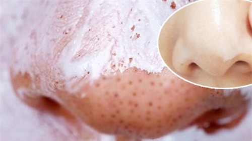 cach tri mun cam, mun dau den voi kem danh rang sieu don gian - 6