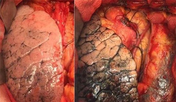 Giám đốc Bệnh viện K điểm mặt 5 bệnh ung thư phổ biến nhất ở Việt Nam - Ảnh 2.