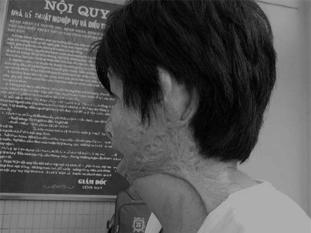 co gai bi chong tam xang dot: "khong dam gap con vi so con hoang loan khi nhin thay me" - 2