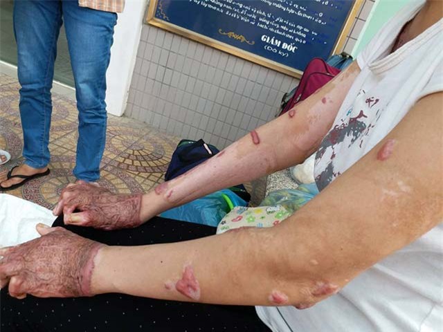 co gai bi chong tam xang dot: "khong dam gap con vi so con hoang loan khi nhin thay me" - 4