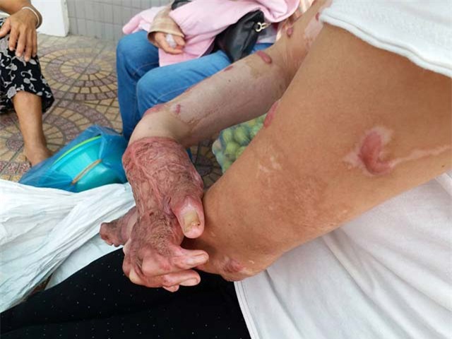 co gai bi chong tam xang dot: "khong dam gap con vi so con hoang loan khi nhin thay me" - 5