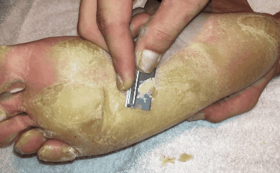 Tưởng vô hại, nhưng các vết chai chân này có thể là dấu hiệu của một căn bệnh cực kỳ nguy hiểm