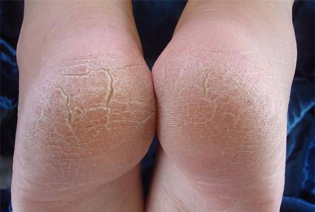 Tưởng vô hại, nhưng các vết chai chân này có thể là dấu hiệu của một căn bệnh cực kỳ nguy hiểm - Ảnh 2.