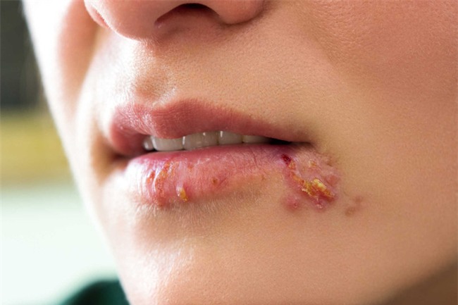 Những nguyên nhân gây mụn vùng kín dù không phải herpes nhưng cũng không thể bỏ qua - Ảnh 3.