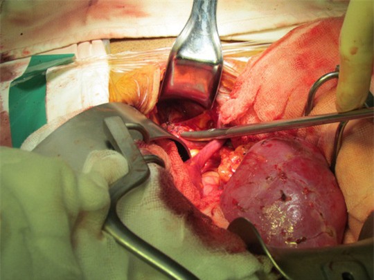 Lần đầu tiên ghép thận cho người lớn tuổi nhất Việt Nam - Ảnh 2.