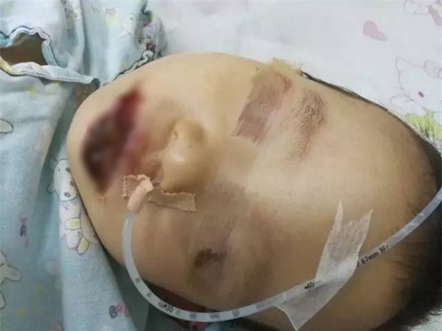 Người lớn bất cẩn, cô bé 2 tuổi bị cháy miệng vì nhầm tưởng chất tẩy rửa siêu mạnh là sữa bột - Ảnh 1.