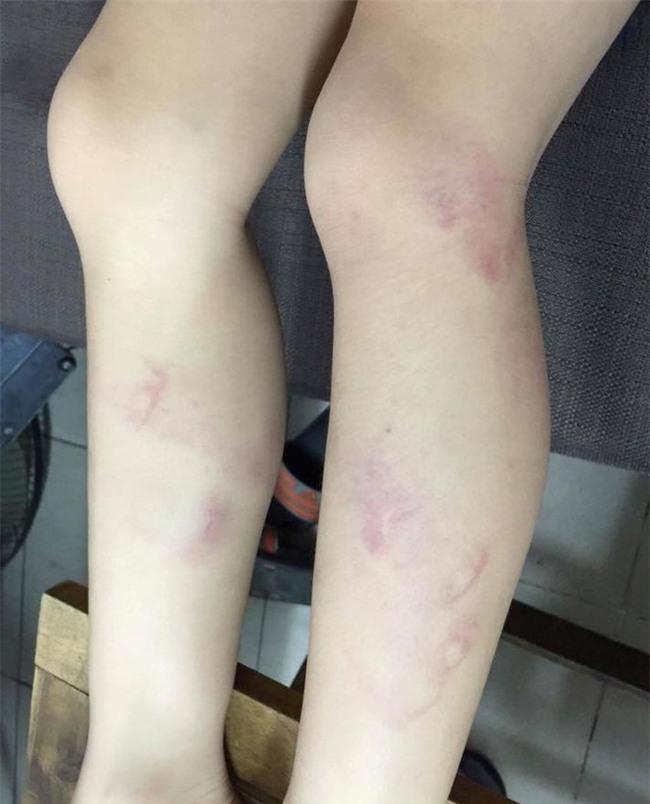Hà Nội: Học sinh vào lớp chậm cô giáo đánh tím tái hai chân đến khi gãy thước ? - Ảnh 1.