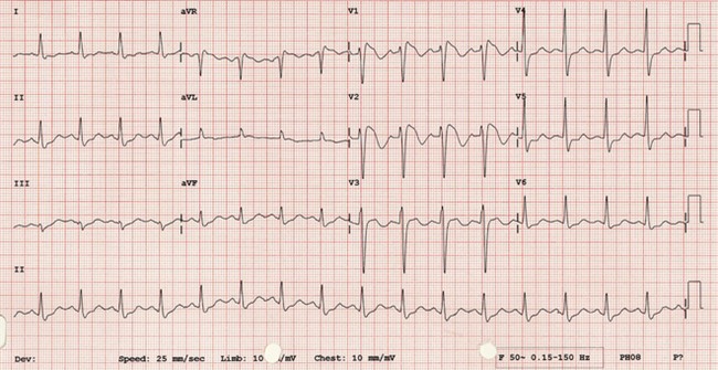Cậu bé 9 tuổi đột ngột ngưng tim sau khi ăn... bánh mì kẹp xúc xích - Ảnh 2.