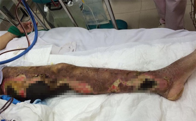 Chân hoại tử bốc mùi hôi thối vì tin 