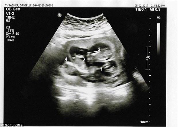 Bà mẹ may mắn nhất quả đất, cứ mỗi lần siêu âm lại phát hiện thêm một em bé trong bụng - Ảnh 2.