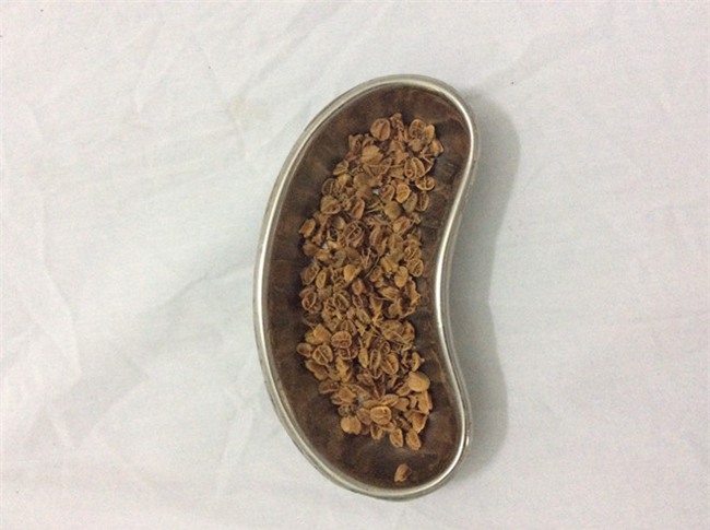 Cau be bi tao bon 4 ngay vi nuot hon 70 gram hat so ri hinh anh 2