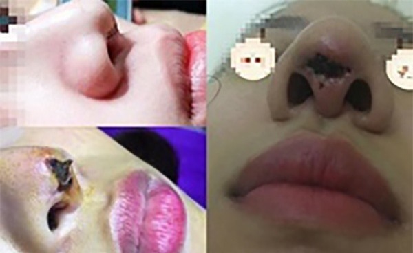 Cạn lời về nguyên nhân xuất hiện thêm lỗ mũi thứ 3 sau phẫu thuật nâng sụn tự thân của cô gái trẻ-2