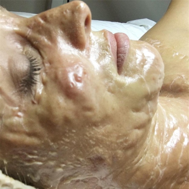 Mặt nạ da rồng làm da bạn sần sùi, lồi lõm kỳ dị nhưng gỡ ra thì lại hồng hào, căng bóng - Ảnh 3.