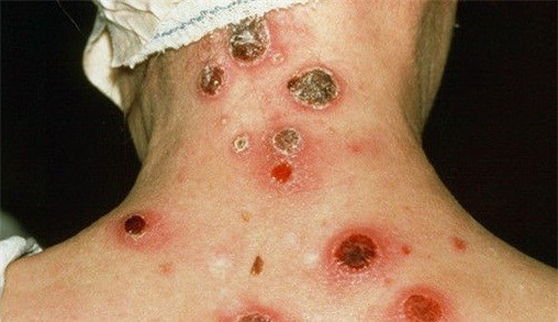 4 benh tinh duc nguy hiem khien ban ngung ngay y dinh "doi gio" - 1