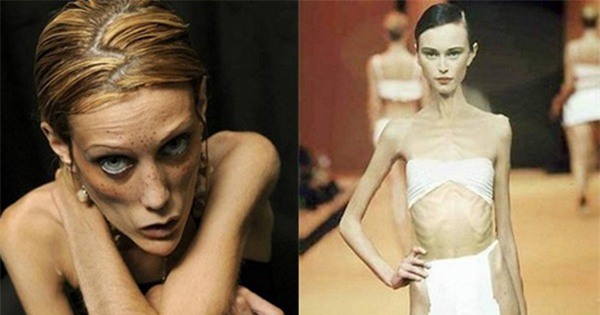 gầy, người gầy, gầy trơ xương