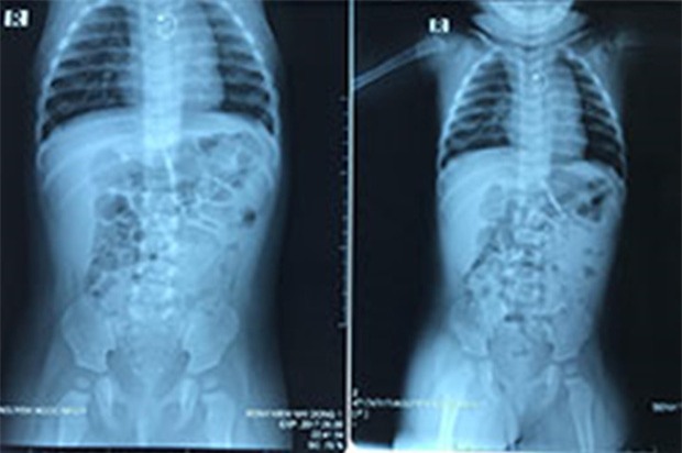 Phụ huynh cẩn trọng: Giật hoa tai của mẹ nuốt vào bụng, bé gái 7 tháng tuổi bị rách thực quản - Ảnh 1.