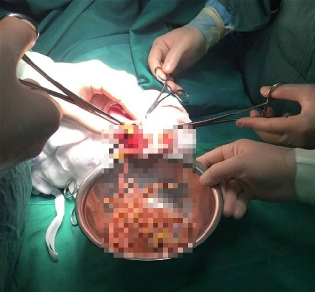 bi dau bung 6 ngay khong khoi, bac si loi ra tui giun lon tu bung be gai 3 tuoi - 1