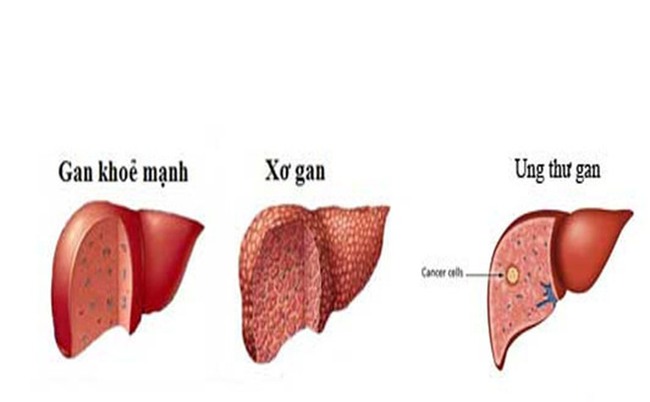 Bệnh gan tại Việt Nam - thực trạng đáng báo động
