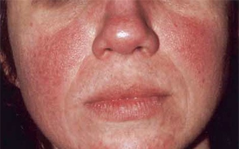 ung thư da, bệnh rosacea, đau tim, huyết khối tĩnh mạch