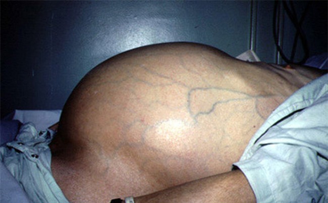 Nguyên nhân gây ung thư gan ít ai ngờ và dấu hiệu nhận biết ung thư gan