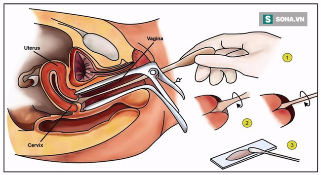 Bệnh ung thư cứ 2 phút có 1 người chết: Điều cần biết về phương pháp tầm soát bệnh - Ảnh 1.