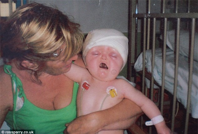 Cũng mắc hội chứng Apert, trải qua 16 cuộc phẫu thuật, cô bé này đã có khuôn mặt xinh đẹp - Ảnh 2.