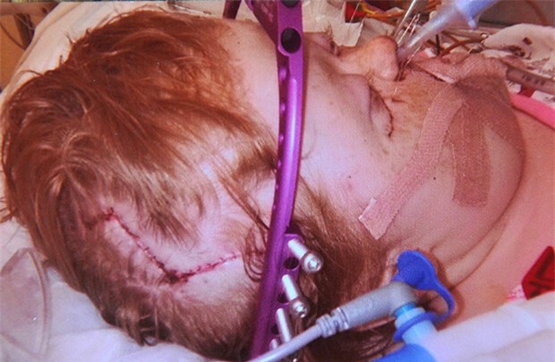 Cũng mắc hội chứng Apert, trải qua 16 cuộc phẫu thuật, cô bé này đã có khuôn mặt xinh đẹp - Ảnh 5.