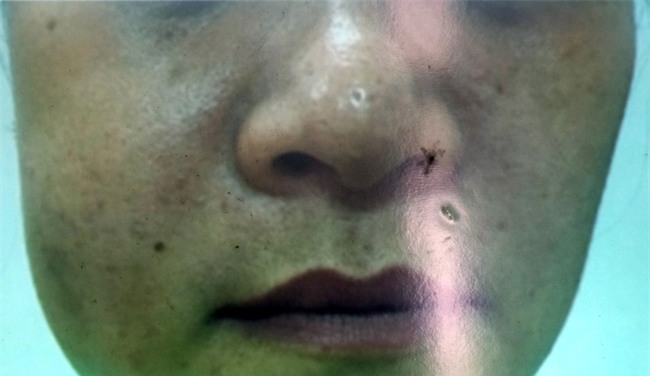 Hai phụ nữ đi làm đẹp “chui”: Người suýt hỏng mũi, kẻ bị biến dạng gò má - Ảnh 3.