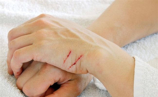 Lạm dụng kháng sinh: Nguy cơ tử vong vì vết xước nhỏ còn nhanh hơn cả ung thư