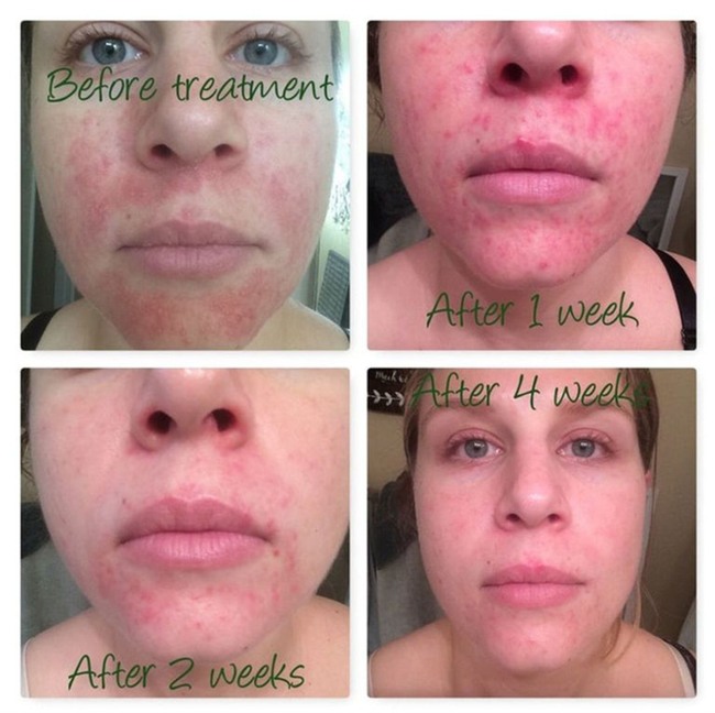 Bị mụn chi chít, cô nàng này đã sử dụng mật ong tươi để đắp mặt và đây là kết quả - Ảnh 5.