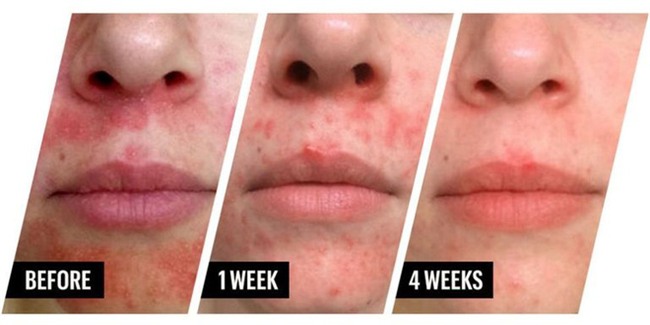 Bị mụn chi chít, cô nàng này đã sử dụng mật ong tươi để đắp mặt và đây là kết quả - Ảnh 6.