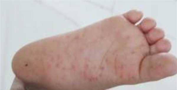 nuot dau, chay nuoc dai la dau hieu som cua benh tay chan mieng - 1