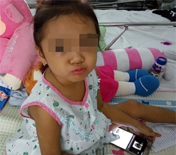 ki la: bac si hi vong khoi u cua benh nhi la u ac tinh - 1