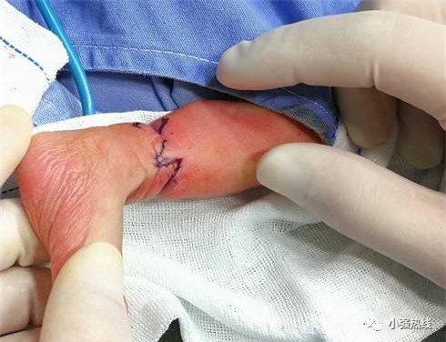 Em bé suýt phải cưa chân vì gặp phải hội chứng hiếm gặp trong thai kỳ - Ảnh 1.