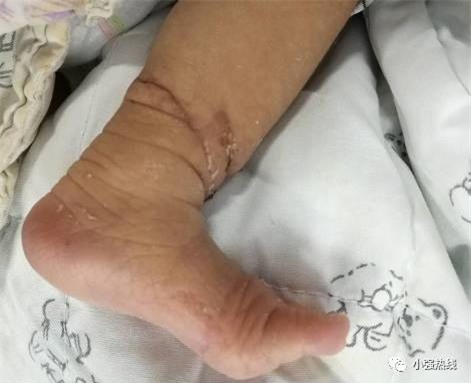 Em bé suýt phải cưa chân vì gặp phải hội chứng hiếm gặp trong thai kỳ - Ảnh 3.