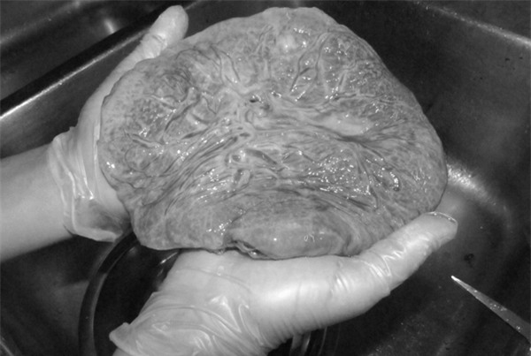 nhau thai, sản phụ