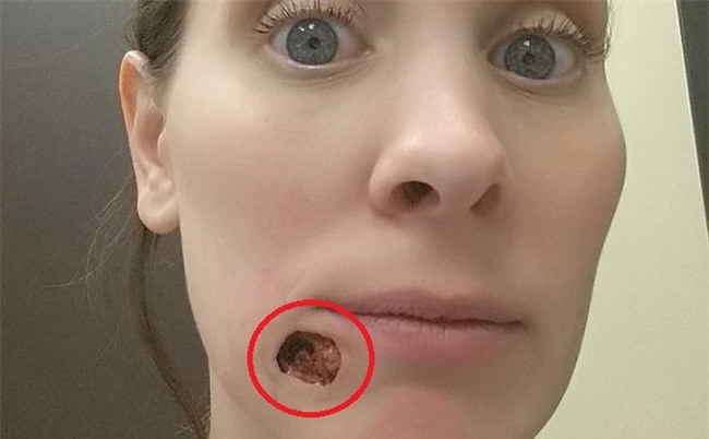 Tưởng là mụn đầu đen, người phụ nữ đã bỏ qua để rồi bị một lỗ hổng to tướng trên khuôn mặt