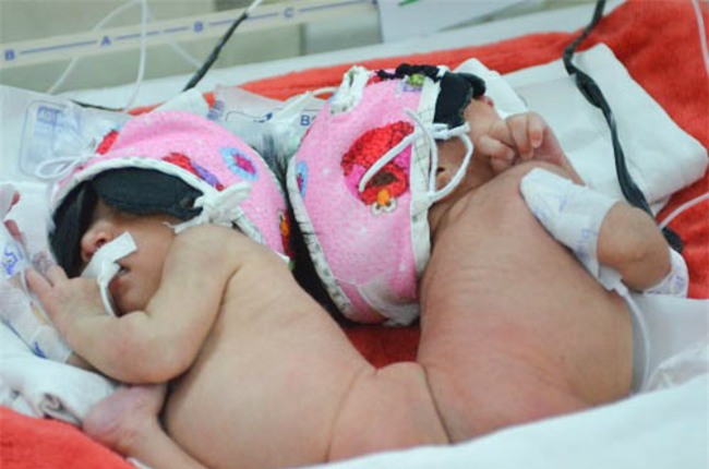 cuoc song moi cua hai be gai song sinh dinh lien mong, khong co hau mon sau hon 1 nam - 2