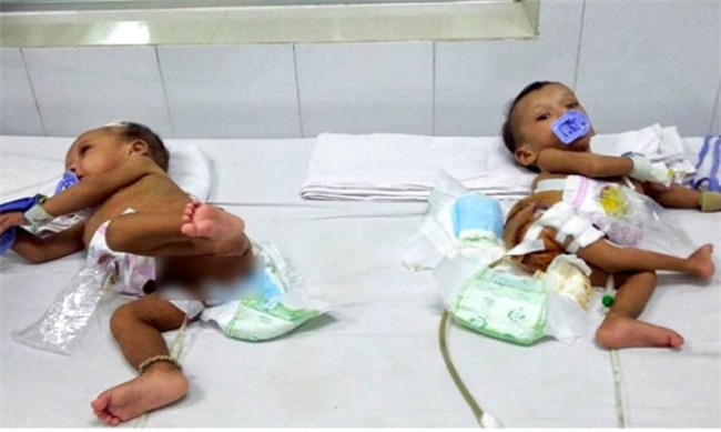 cuoc song moi cua hai be gai song sinh dinh lien mong, khong co hau mon sau hon 1 nam - 3