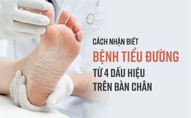Khi có 4 dấu hiệu này ở bàn chân, có thể bạn đã rơi vào 